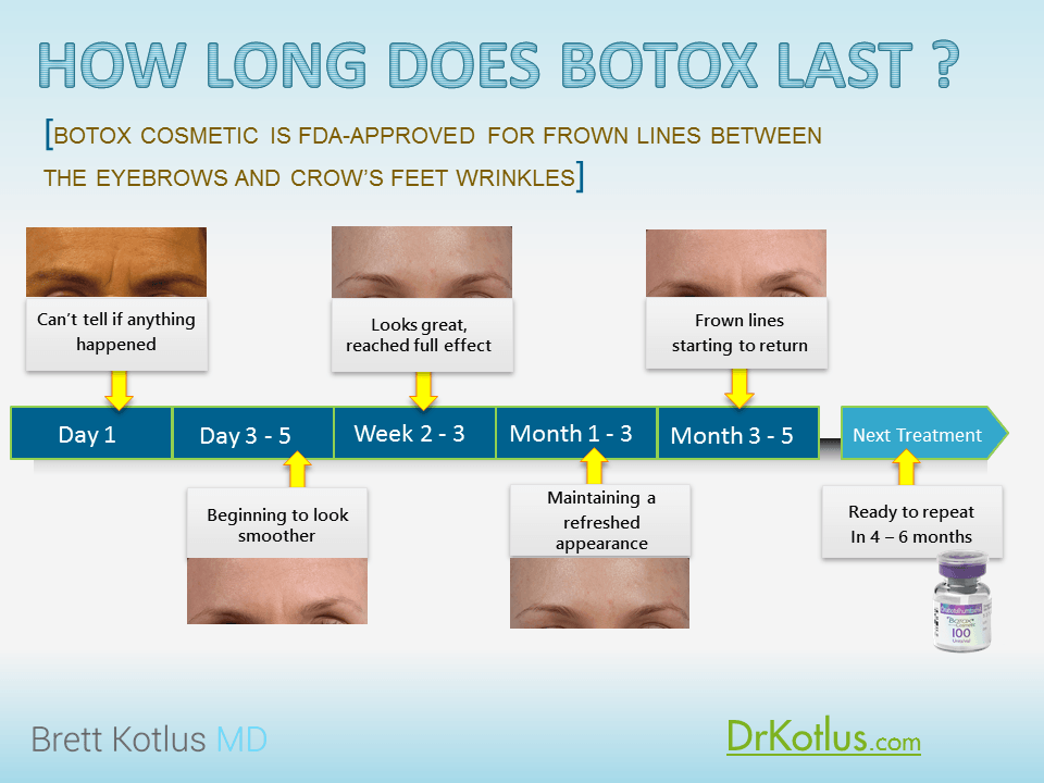 botox duration