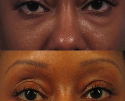 Dr. brett kotlus cosmetic oculoplastic lower eye lift
