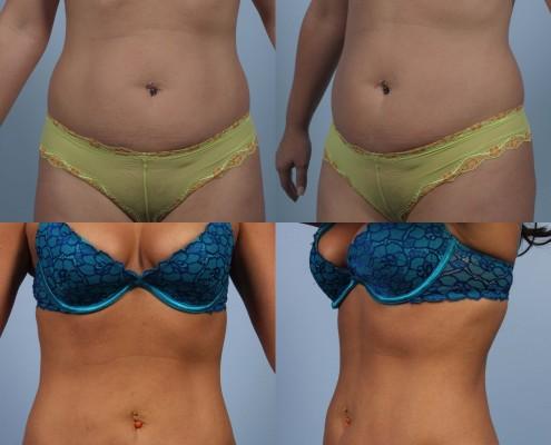 Dr. brett kotlus cosmetic oculoplastic liposuction abdomen laser