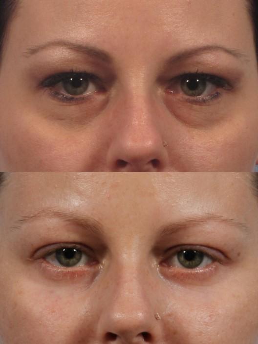 Dr. brett kotlus cosmetic oculoplastic blepharoplasty lower ny