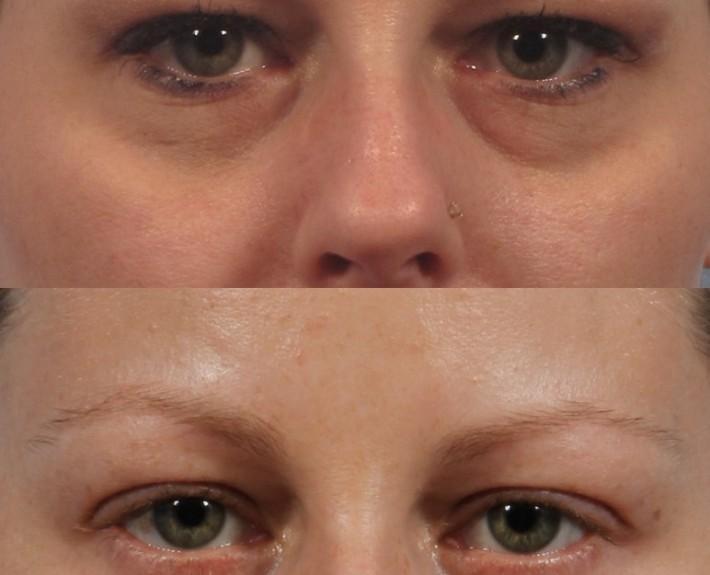 Dr. brett kotlus cosmetic oculoplastic blepharoplasty lower ny