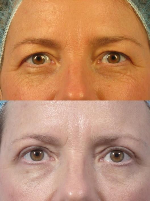 Dr. brett kotlus cosmetic oculoplastic upper blepharoplasty