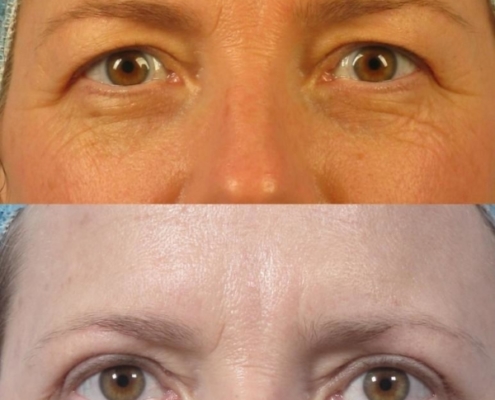 Dr. brett kotlus cosmetic oculoplastic upper blepharoplasty