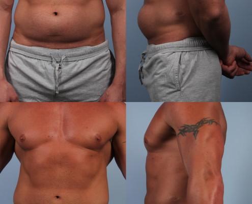 Dr. brett kotlus cosmetic oculoplastic liposuction male bodybuilder