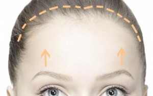 bicoronal-brow