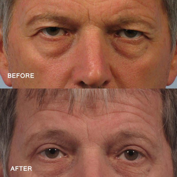 Dr. brett kotlus cosmetic oculoplastic upper eye job man