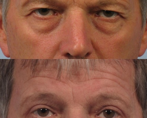 Dr. brett kotlus cosmetic oculoplastic upper blepharoplasty