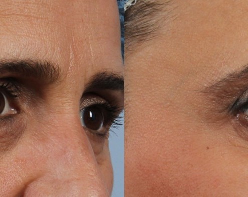 Dr. brett kotlus cosmetic oculoplastic smile wrinkles botox nyc