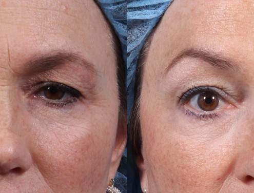 Dr. brett kotlus cosmetic oculoplastic botox brow