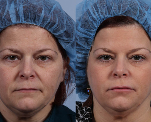 Dr. brett kotlus cosmetic oculoplastic botox