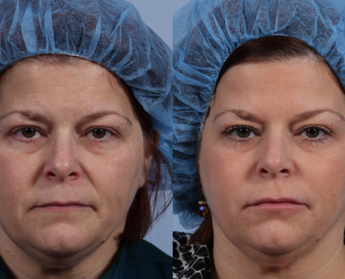 Dr. brett kotlus cosmetic oculoplastic dysport brows