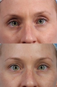 Dr. brett kotlus cosmetic oculoplastic nyc botox eyes