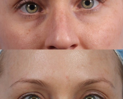 Dr. brett kotlus cosmetic oculoplastic nyc botox eyes