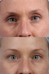 Dr. brett kotlus cosmetic oculoplastic botox new york