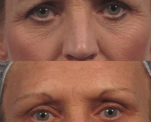 eyebrow lift surgery nyc