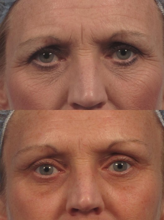 eyebrow lift surgery nyc