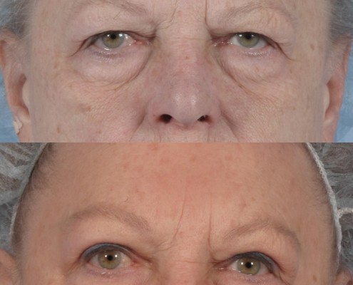 Dr. brett kotlus cosmetic oculoplastic nyc eyebrow lift