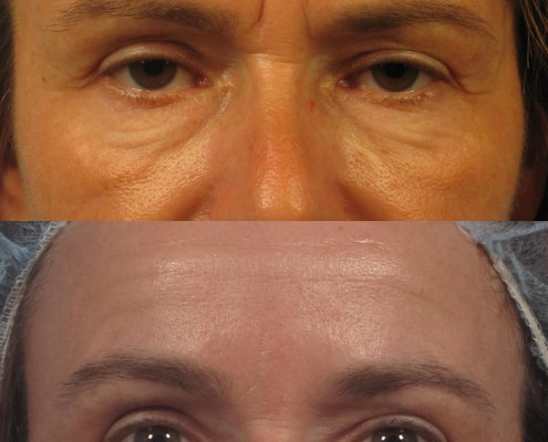 Dr. brett kotlus cosmetic oculoplastic filler and botox