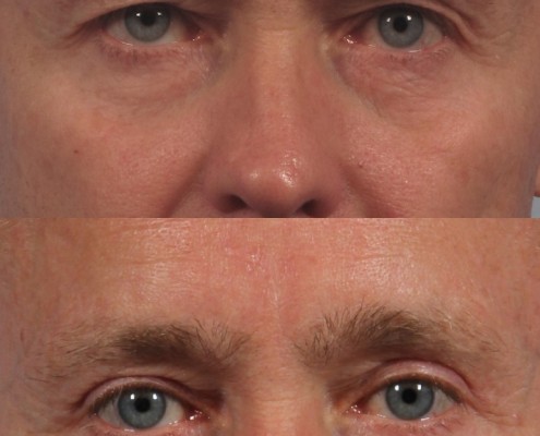 Dr. brett kotlus cosmetic oculoplastic upper eyelid male