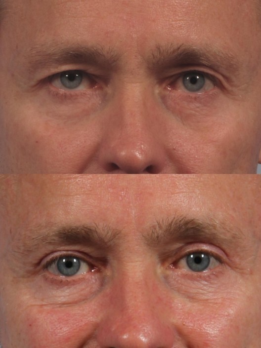 Dr. brett kotlus cosmetic oculoplastic upper eyelid male
