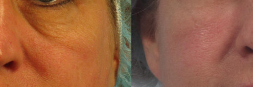 Dr. brett kotlus cosmetic oculoplastic juvederm voluma