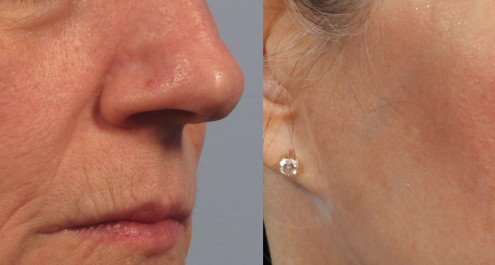 Dr. brett kotlus cosmetic oculoplastic juvederm