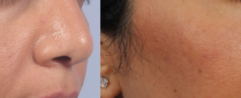 Dr. brett kotlus cosmetic oculoplastic cheek sculptra