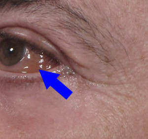 Dr. brett kotlus cosmetic oculoplastic chemosis