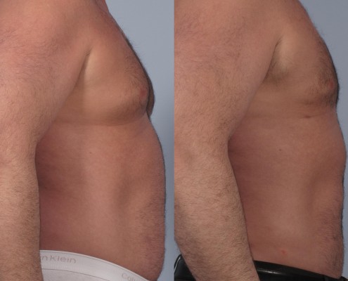 Dr. brett kotlus cosmetic oculoplastic liposuction man