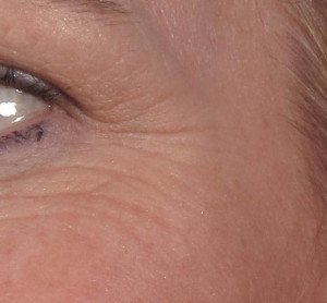 Dr. brett kotlus cosmetic oculoplastic crows feet