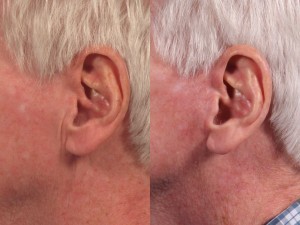 Dr. brett kotlus cosmetic oculoplastic nyc facelift scars
