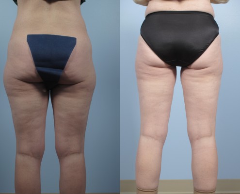 Dr. brett kotlus cosmetic oculoplastic liposuction outer thighs ny