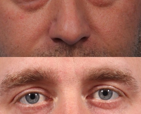 Dr. brett kotlus cosmetic oculoplastic lower blepharoplasty nyc