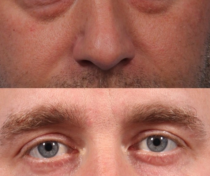 Dr. brett kotlus cosmetic oculoplastic lower blepharoplasty nyc