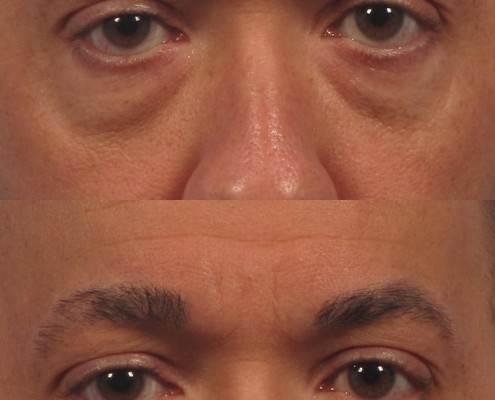 Under Eye Fillers  Before  After Results at Skinly