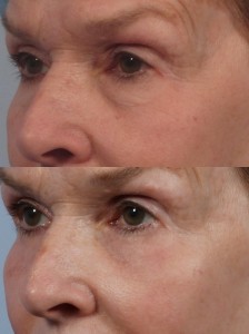 dr. brett kotlus blepharoplasty lower