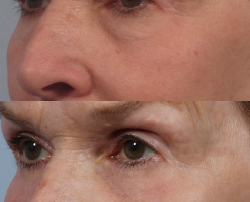 dr. brett kotlus blepharoplasty lower