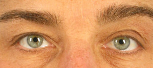 Dr. brett kotlus cosmetic oculoplastic eyelid asymmetry