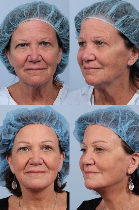 browlift facelift nyc