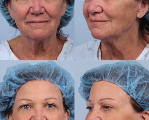 browlift facelift nyc