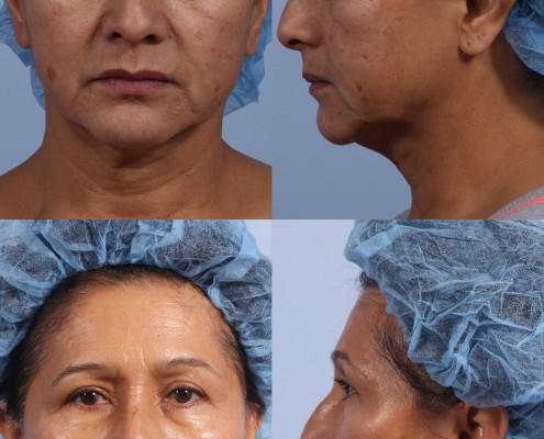 Dr. brett kotlus cosmetic oculoplastic nyc neck lift