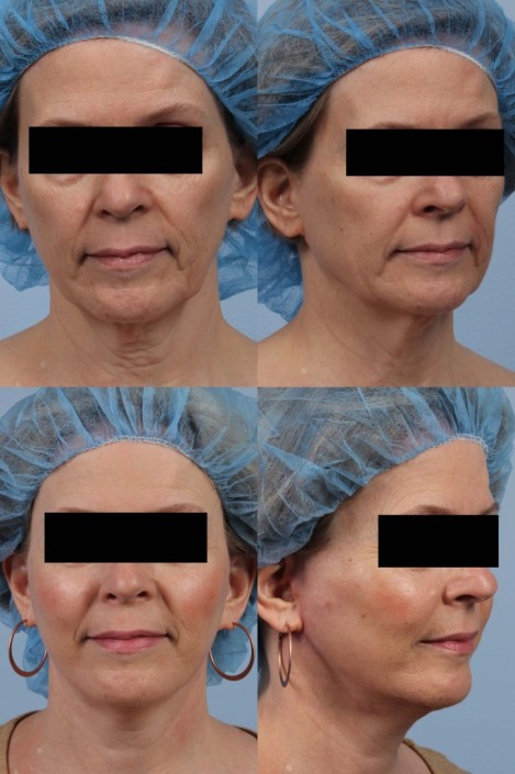 nyc fat grafting facelift