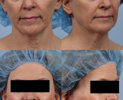 nyc fat grafting facelift