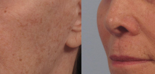 Dr. brett kotlus cosmetic oculoplastic cheek fat transfer