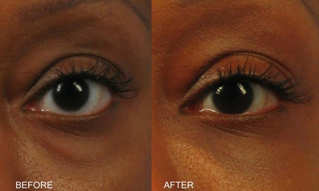 Dr. brett kotlus cosmetic oculoplastic eyelid transposition