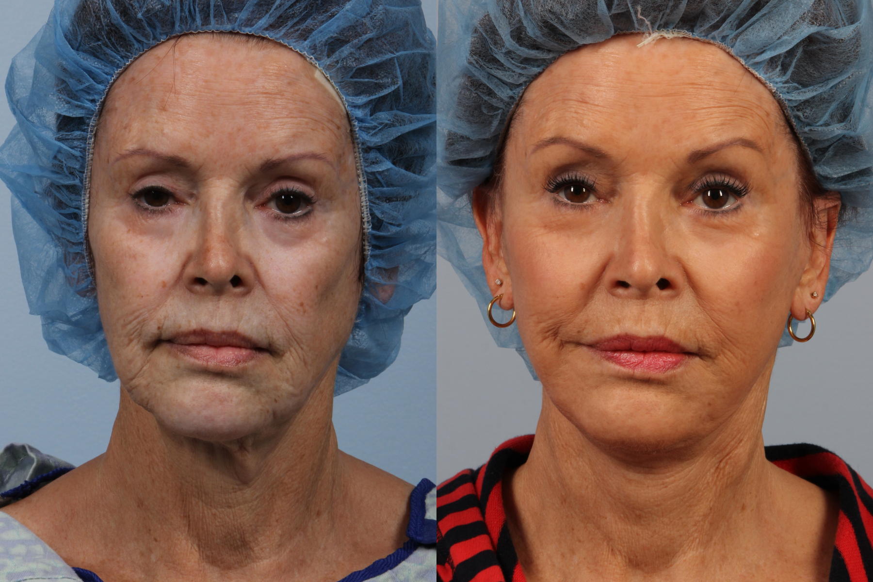 nyc facelift surgeons