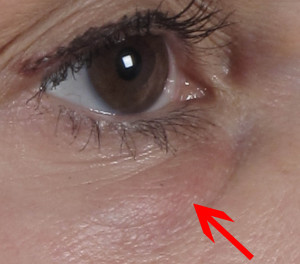 Dr. brett kotlus cosmetic oculoplastic filler