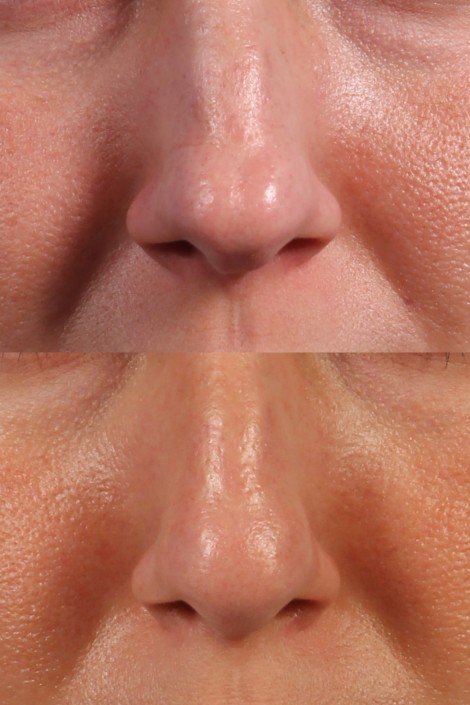 nasal tip filler