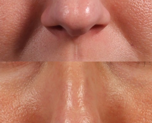 nasal tip filler