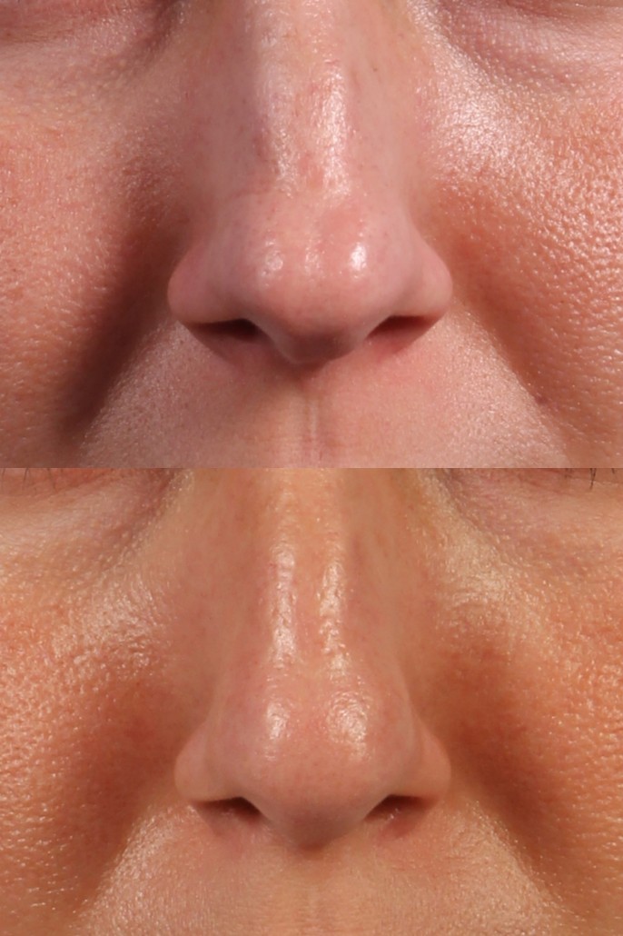 Nose Shaping With Surgery or Nose Filler? | Dr. Brett Kotlus, Cosmetic
